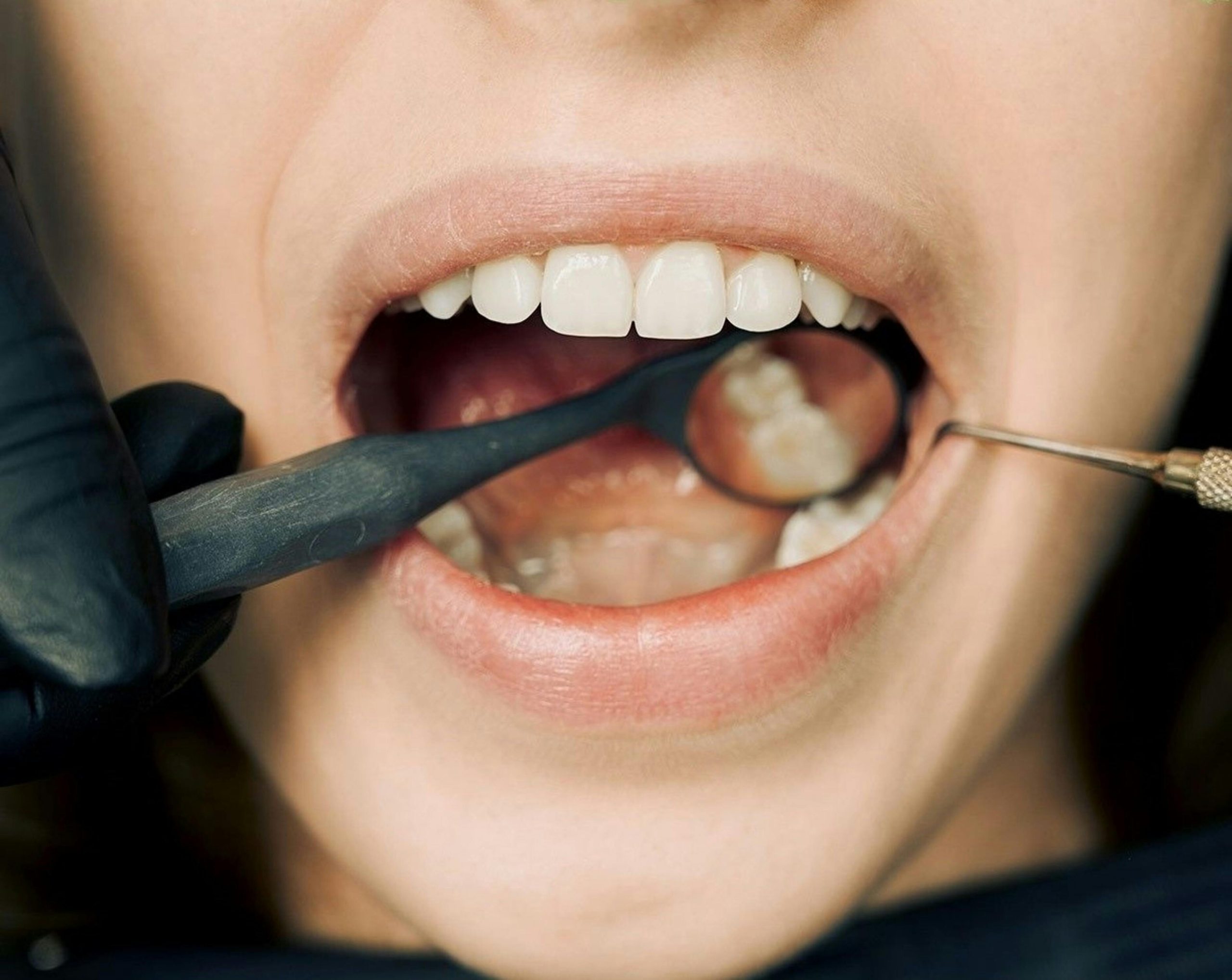 Dentist tools in patients mouth