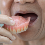 Managing Denture Stomatitis: Diagnosis, Treatment, and Prevention